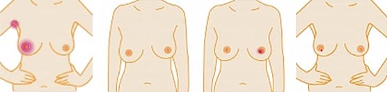 Meme Kanserinin Erken Belirtileri Nelerdir?